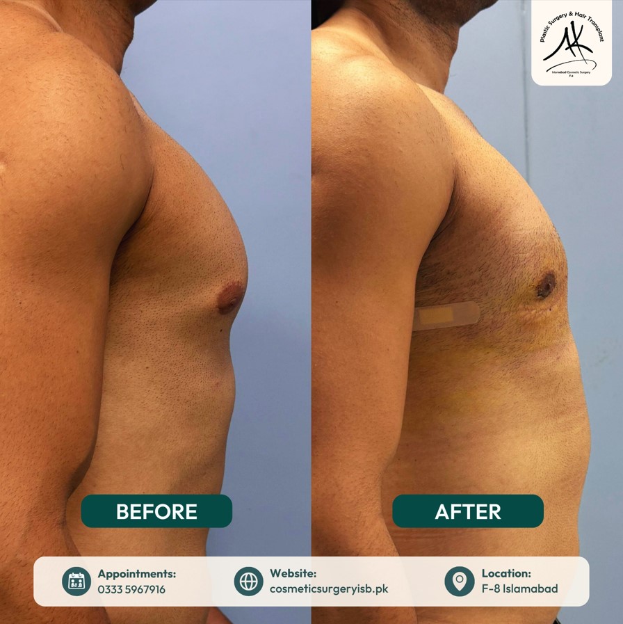 Gynecomastia before and after Islamabad