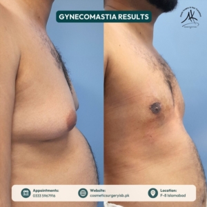 Cosmetic surgery team Islamabad for gynecomastia