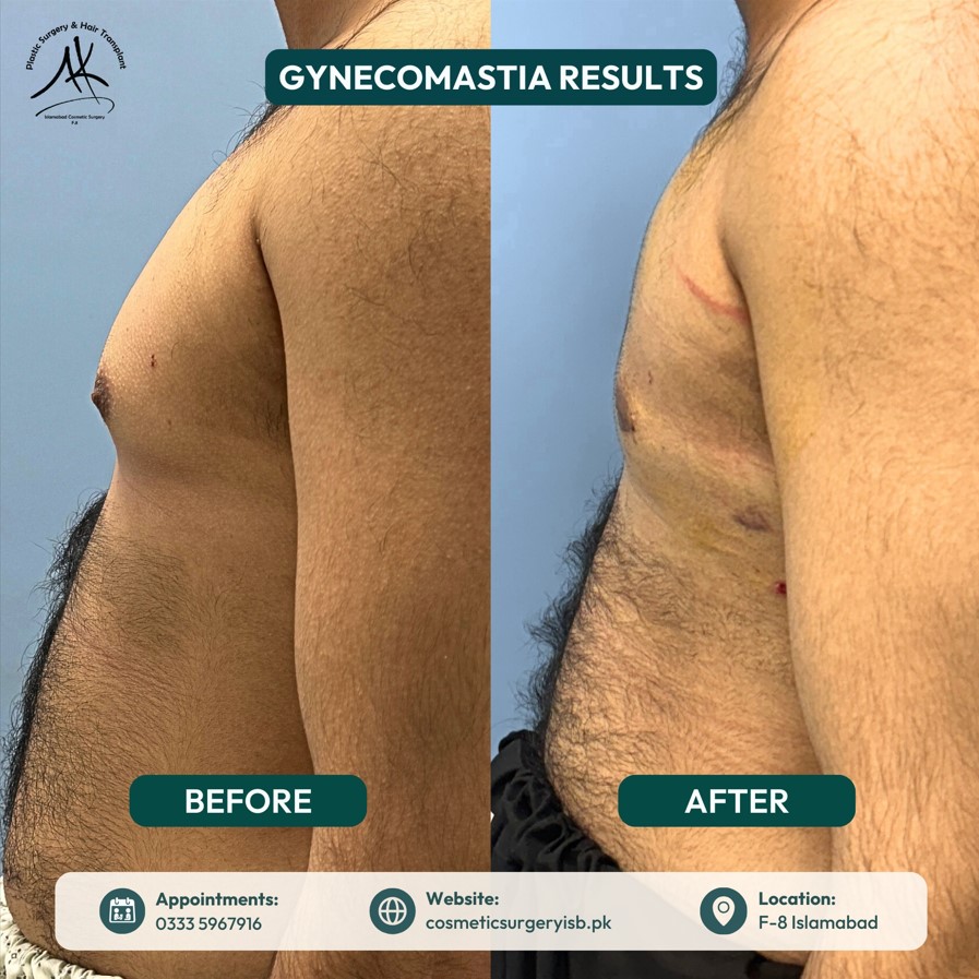 Patient testimonial gynecomastia Islamabad