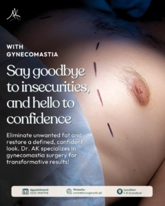 Gynecomastia treatment before and after Islamabad